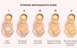 Физиологическая желтуха у новорожденного