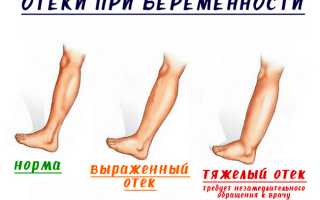 Почему у беременных отекают ноги и как снять отеки
