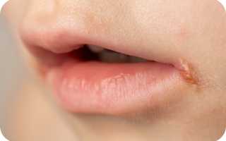 Как лечить хейлит на губах?