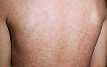 Лечение опоясывающего лишая в домашних условиях