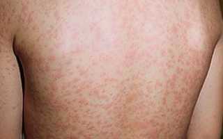 Лечение опоясывающего лишая в домашних условиях