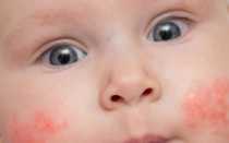 Как лечить диатез у ребенка?