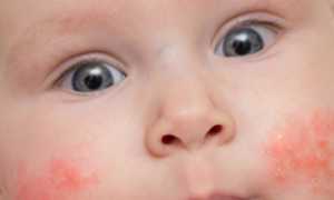 Как лечить диатез у ребенка?